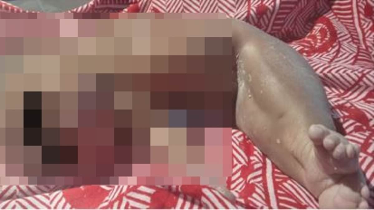 Tragic 'mermaid baby' is born with lower body fused together and no genitalia