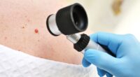 'Exciting' skin cancer vaccine halves risk of relapse or death in study