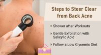 Banish Back Acne: Effective Treatments and Tips