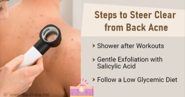 Banish Back Acne: Effective Treatments and Tips