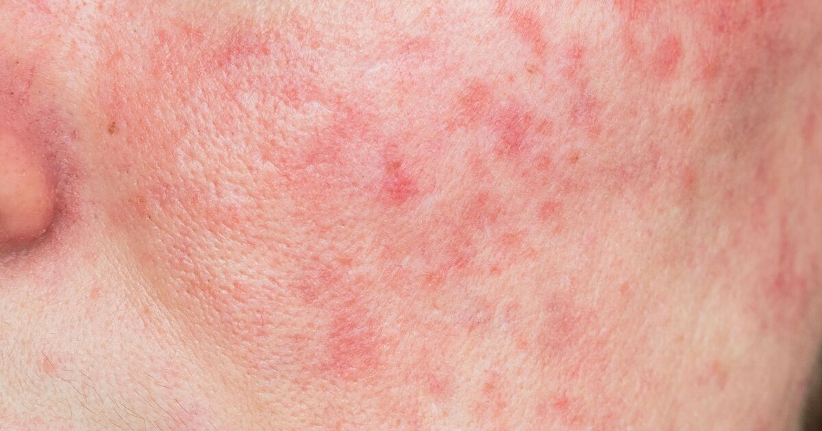 Common food items that could be making your skin worse