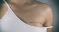 Why a Mastectomy may not work as well as just removing the lump