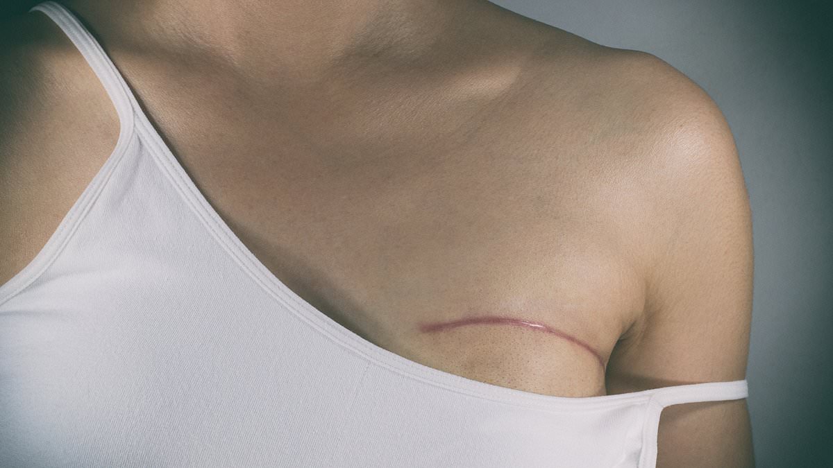 Why a Mastectomy may not work as well as just removing the lump