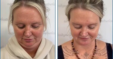 Breakthrough needle-free treatment that experts claim can get rid of neck fat in just 20 minutes becomes available in the UK