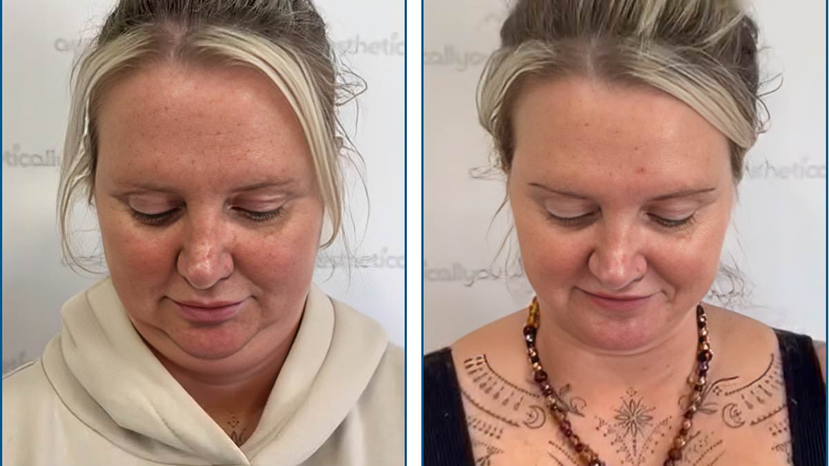 Breakthrough needle-free treatment that experts claim can get rid of neck fat in just 20 minutes becomes available in the UK