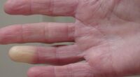 Little-known Victorian condition that affects fingers and toes