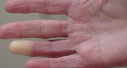 Little-known Victorian condition that affects fingers and toes