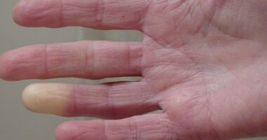 Little-known Victorian condition that affects fingers and toes