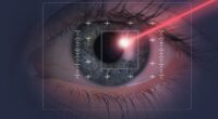 Risks of popular laser eye surgery may be MUCH higher than clinics claim: Everything you should know about chances of potential long-term side-effects - from permanent scarring and agonising pain to being left suicidal - before opting for £4,000 operation