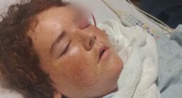 Texas boy, 13, left with plastic pipe sticking out of his head after swim with friends triggered illness that could have killed him