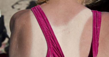 Best moisturisers to treat sunburn – and one you must avoid completely