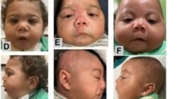 Dozens of babies diagnosed with new condition linked to fentanyl that causes deformed heads, conjoined toes and clubbed fingers