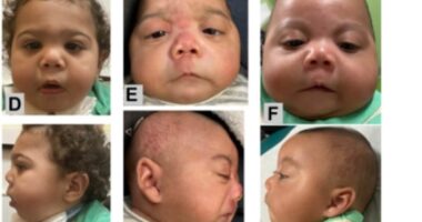 Dozens of babies diagnosed with new condition linked to fentanyl that causes deformed heads, conjoined toes and clubbed fingers