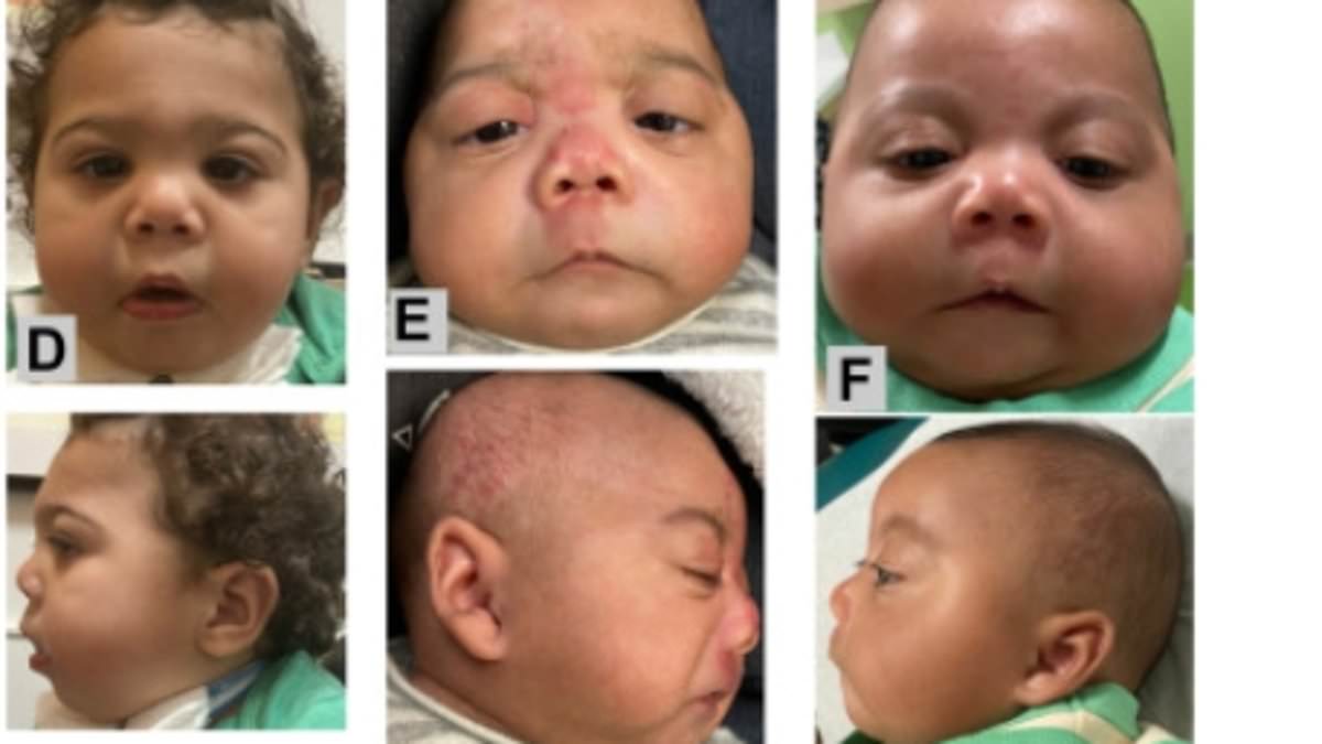 Dozens of babies diagnosed with new condition linked to fentanyl that causes deformed heads, conjoined toes and clubbed fingers