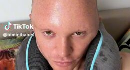 Drag race star reveals severely swollen head triggered by hair transplant surgery that 'makes me look like Sloth from the Goonies'