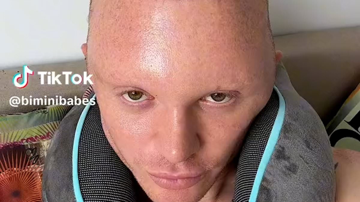 Drag race star reveals severely swollen head triggered by hair transplant surgery that 'makes me look like Sloth from the Goonies'