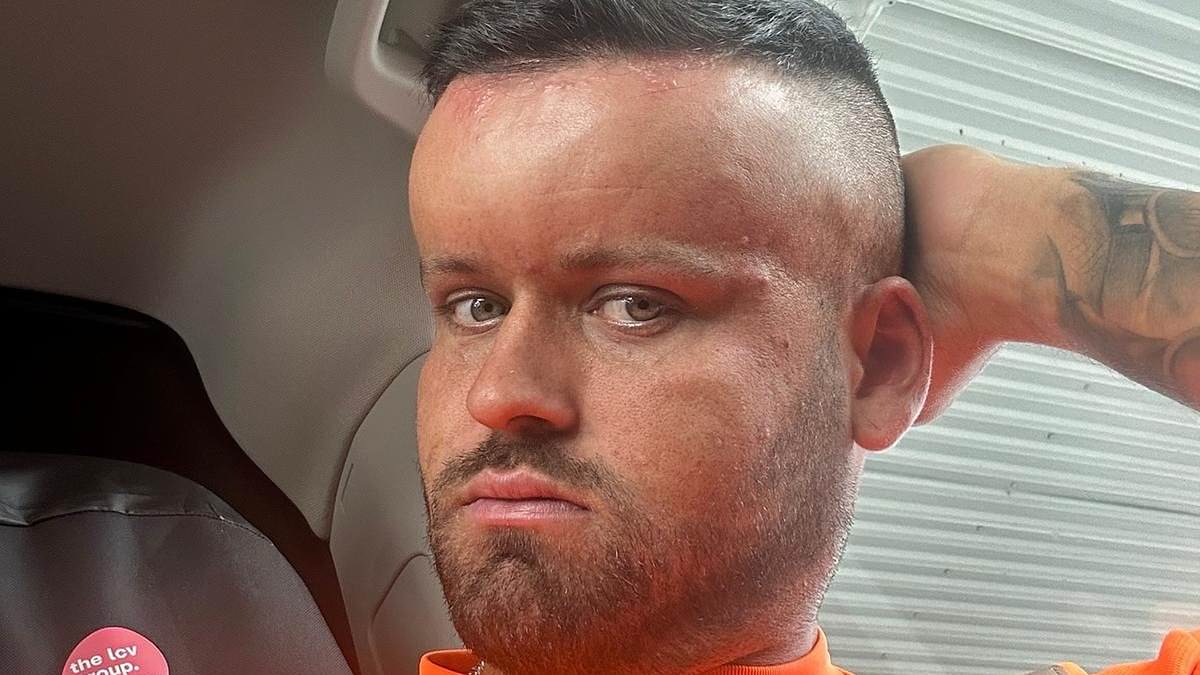 Horror hair dye reaction left man, 27, with a giant 'BALLOON HEAD' like the cartoon character Megamind