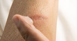 How to get rid of itchy scars at home with dermatologist's effective remedies