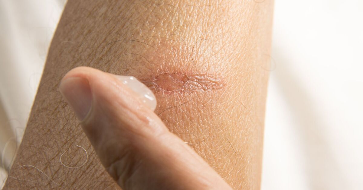 How to get rid of itchy scars at home with dermatologist's effective remedies