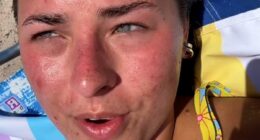 Insane TikTok trend for 'sunburning' which influencers claim can heal acne and boost immunity... but doctors warn against trying it