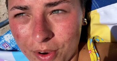 Insane TikTok trend for 'sunburning' which influencers claim can heal acne and boost immunity... but doctors warn against trying it