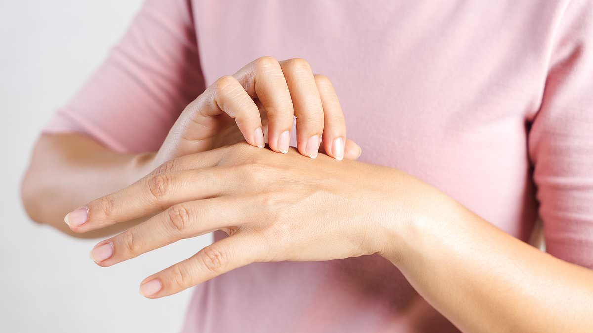 Relief for sufferers of hand eczema as watchdog poised to approve first drug