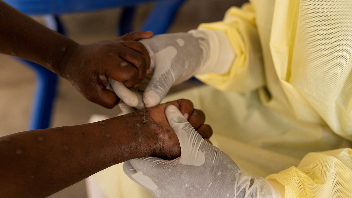 UK doctors are put on alert over spread of deadly new variant of mpox virus - after WHO declared global health emergency following outbreak in Africa