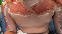 Horrifying images show danger of buying suncream abroad - as 10 year-old is hospitalised with agonising burns after applying SPF90