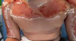 Horrifying images show danger of buying suncream abroad - as 10 year-old is hospitalised with agonising burns after applying SPF90