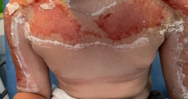 Horrifying images show danger of buying suncream abroad - as 10 year-old is hospitalised with agonising burns after applying SPF90