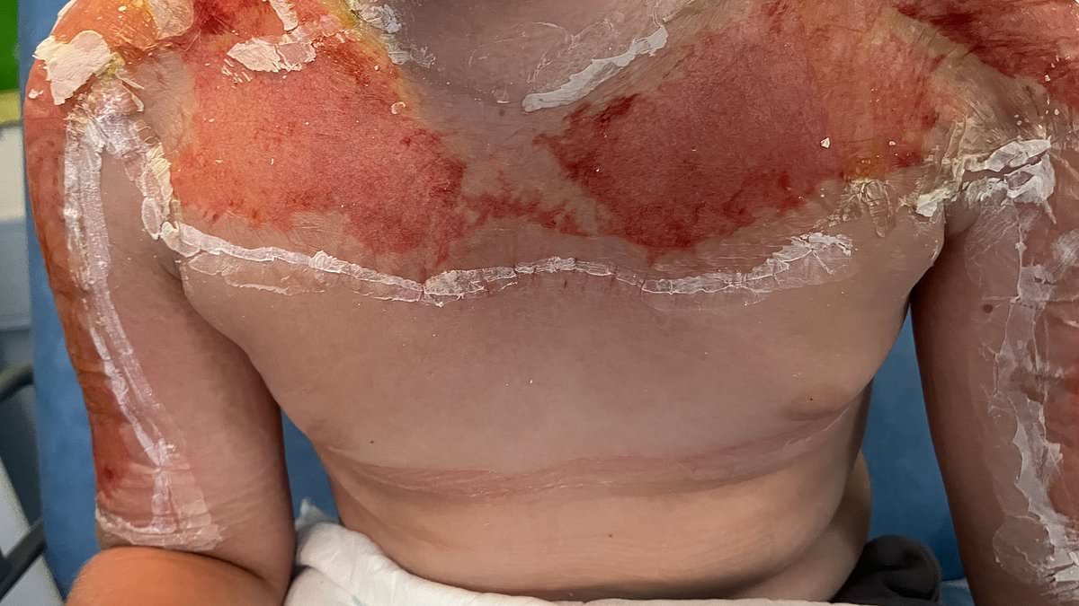 Horrifying images show danger of buying suncream abroad - as 10 year-old is hospitalised with agonising burns after applying SPF90