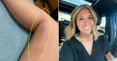 Mom reveals how subtle red mark was actually sign she was suffering a silent health emergency