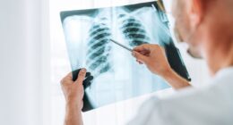 Silent threat that could crack the mystery of lung cancers in non-smokers