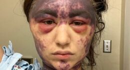 Vaccine horror as woman, 23, claims she was left temporarily BLIND and with agonizing bruises all over her body after reaction to 'superdose'