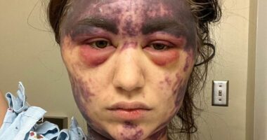 Vaccine horror as woman, 23, claims she was left temporarily BLIND and with agonizing bruises all over her body after reaction to 'superdose'