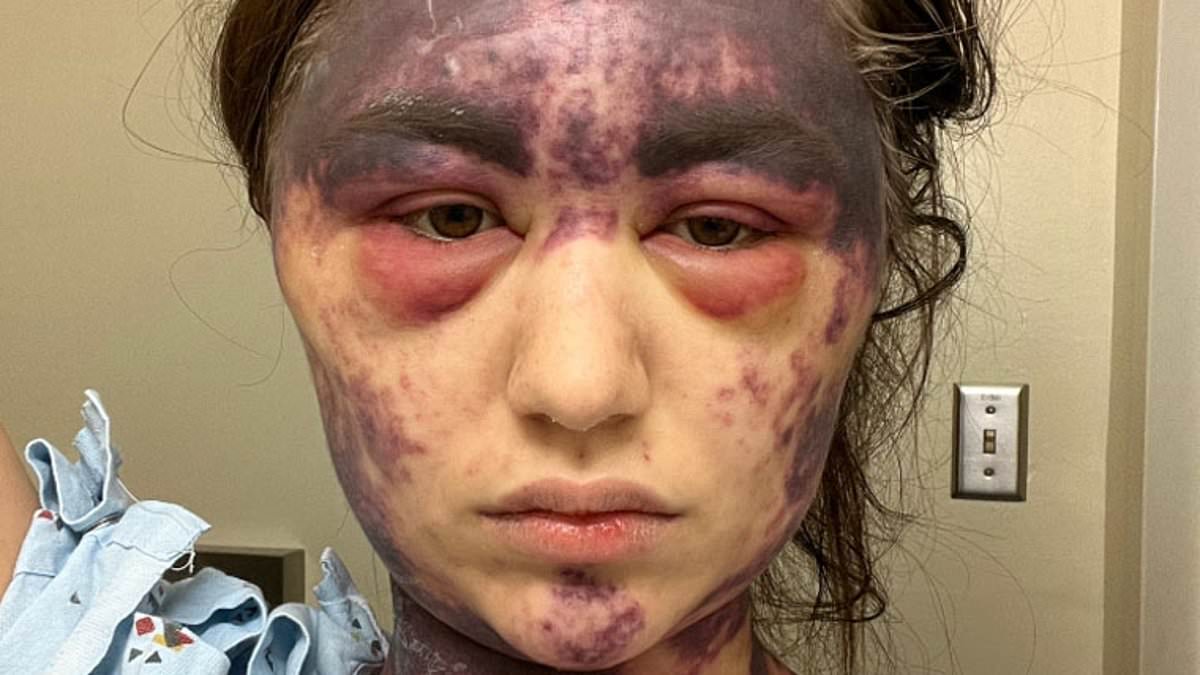 Vaccine horror as woman, 23, claims she was left temporarily BLIND and with agonizing bruises all over her body after reaction to 'superdose'