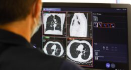 Global cancer explosion: Experts discover nations where you're most likely to die of the disease - it doesn't look good for the UK