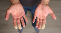 Got cold hands? Take the 1-minute test that reveals if you have debilitating Raynaud's disease