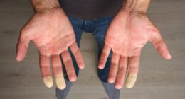 Got cold hands? Take the 1-minute test that reveals if you have debilitating Raynaud's disease