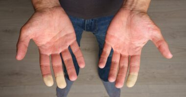 Got cold hands? Take the 1-minute test that reveals if you have debilitating Raynaud's disease