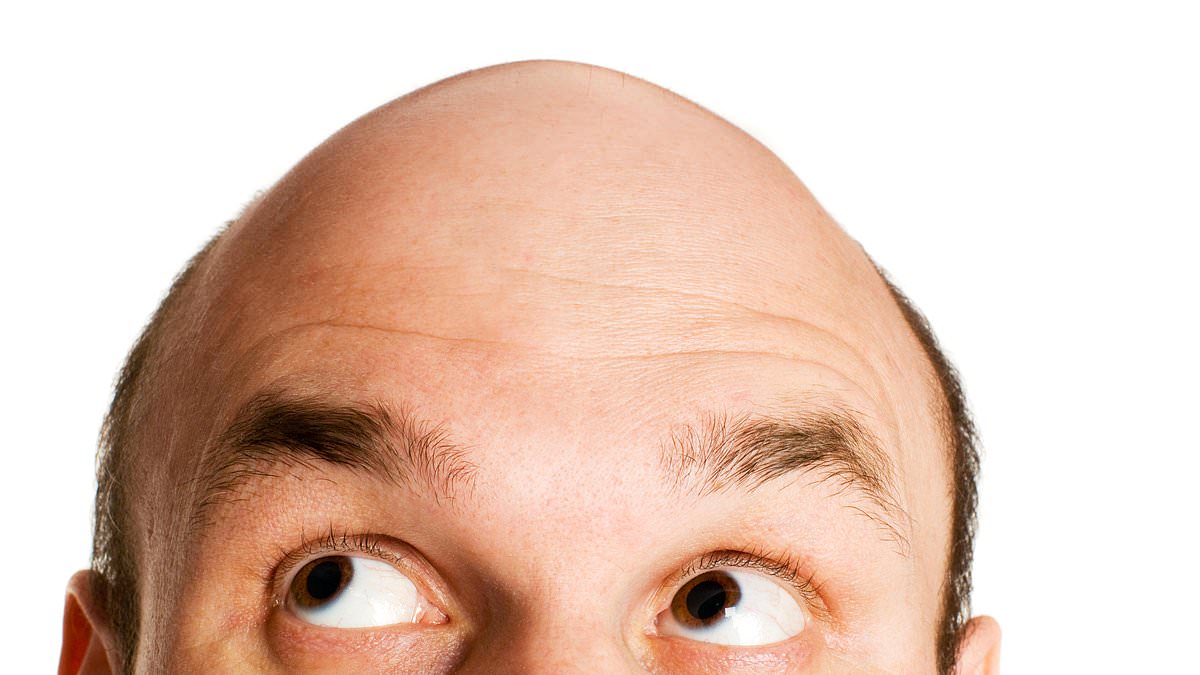 Diet followed by millions could be driving hair loss, new study suggests