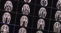 New Alzheimer's hope as study finds 'key to reversing disease'