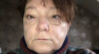 'I dismissed my puffy eyes as tiredness but they were symptom of rare cancer'