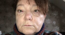 'I dismissed my puffy eyes as tiredness but they were symptom of rare cancer'