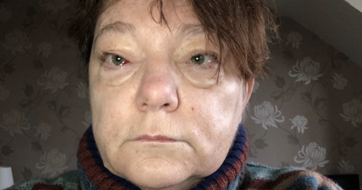 'I dismissed my puffy eyes as tiredness but they were symptom of rare cancer'