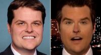 Plastic surgeons explain what happened to Matt Gaetz's face