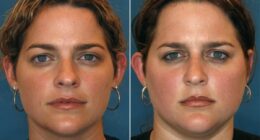 Study of dozens of identical twins reveals shocking effect bad diet and divorce has on your face