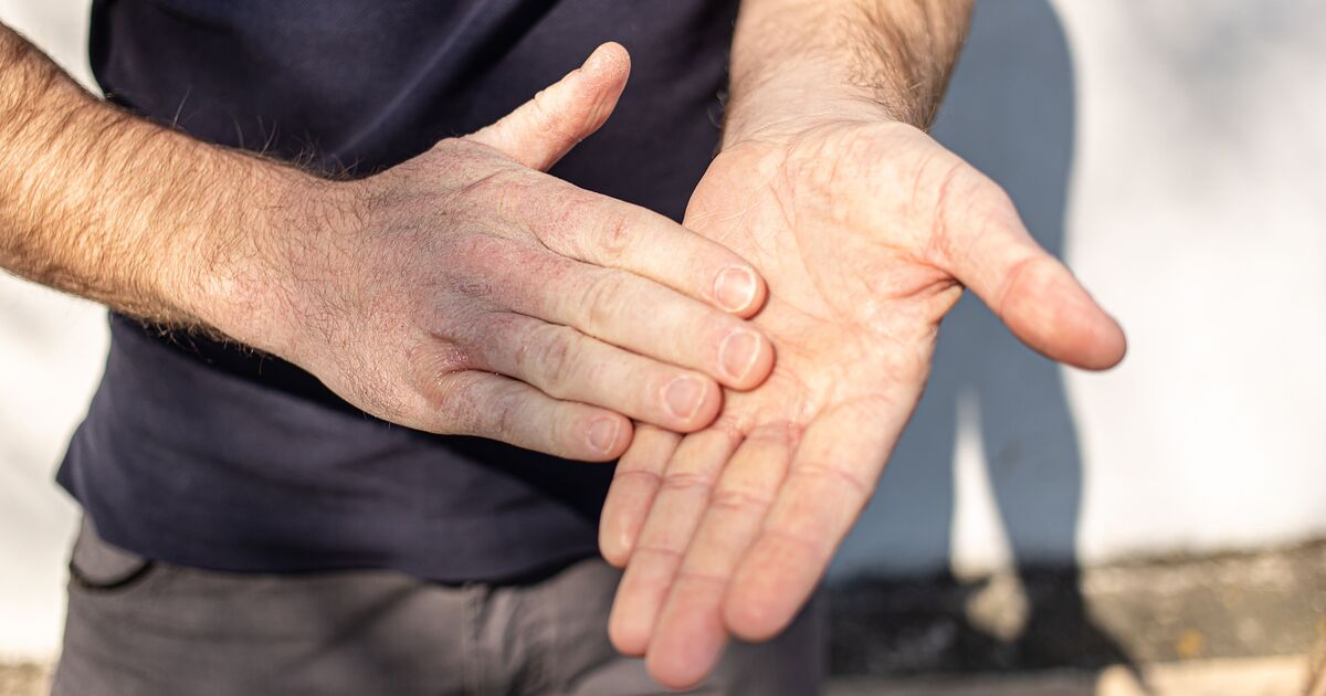 Three unusual signs on your hands that could mean your liver is failing