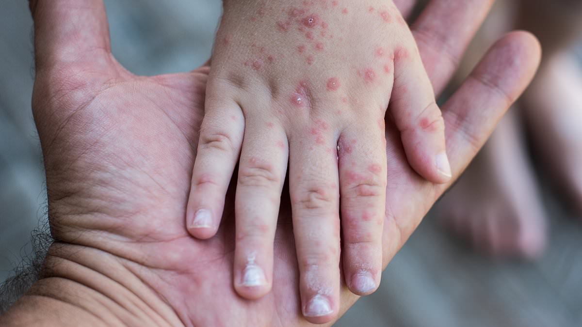 Pediatrician working in the heart of Texas measles outbreak warns it's 'just the beginning' with cases surging to 90