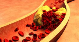 Seven-day cholesterol-lowering meal plan by cardiac experts may reduce statin dependency